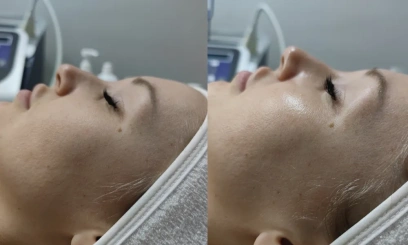 Молочный пилинг